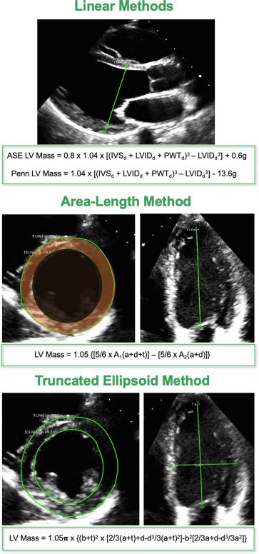 Normal Values of Left Ventricular Mass by Two